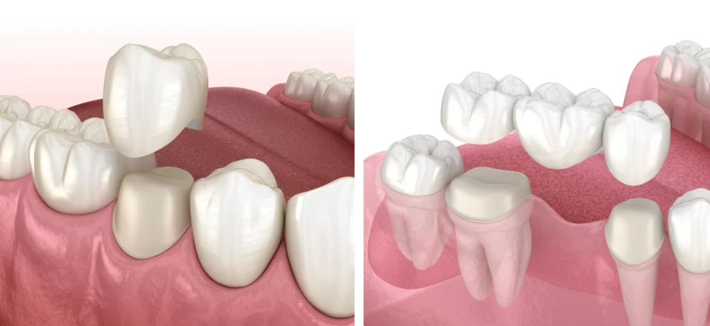 couronnes ponts traditionnel couronnes ponts traditionnel Traitements Cabinet du château - Dr Simon KOENIG