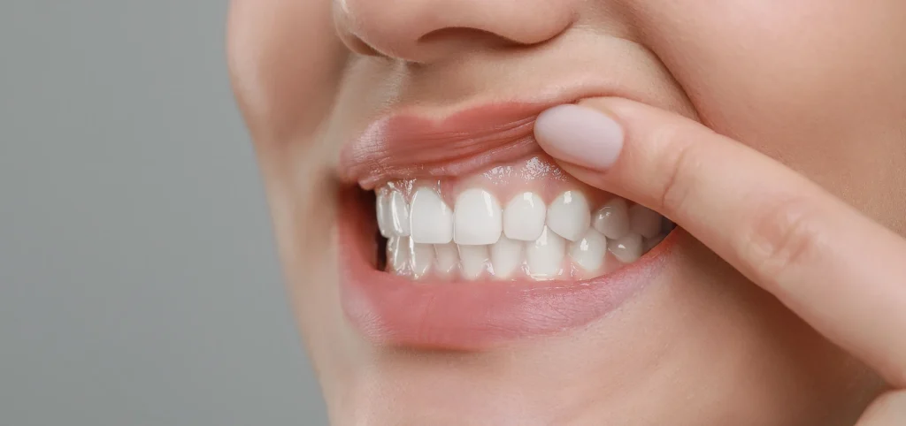 soins gencives Soins de gencives Cabinet du château - Dr Simon KOENIG