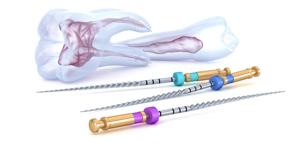 endodontie devitalisation endodontie devitalisation Traitements Cabinet du château - Dr Simon KOENIG