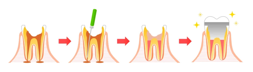 endodontie traitements canal endodontie traitements canal Endodontie Cabinet du château - Dr Simon KOENIG