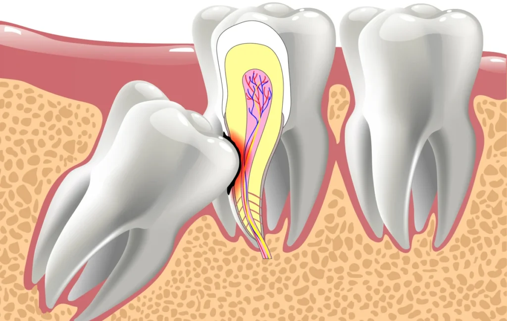 dents sagesse dentiste gisors Extraction de dents de sagesse Cabinet du château - Dr Simon KOENIG