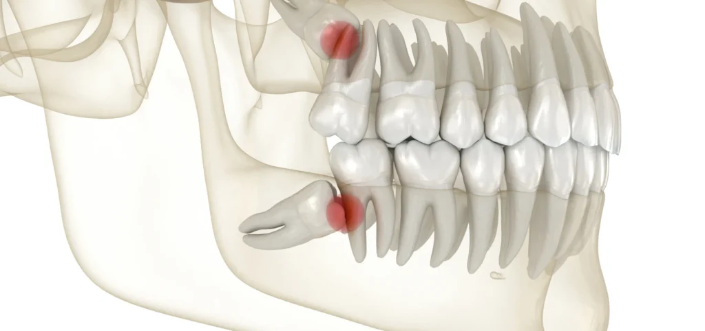 extraction dents sagesse dentiste gisors extraction dents sagesse dentiste gisors Traitements Cabinet du château - Dr Simon KOENIG