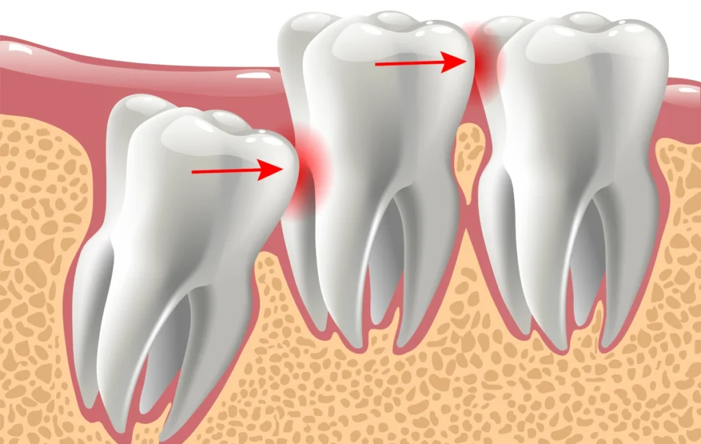 extraction dents sagesse gisors Extraction de dents de sagesse Cabinet du château - Dr Simon KOENIG